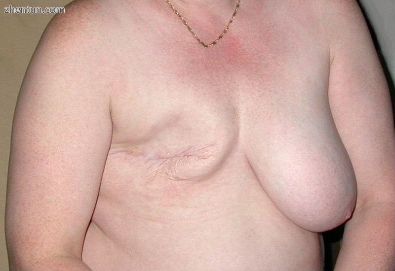 Person following a mastectomy.jpg