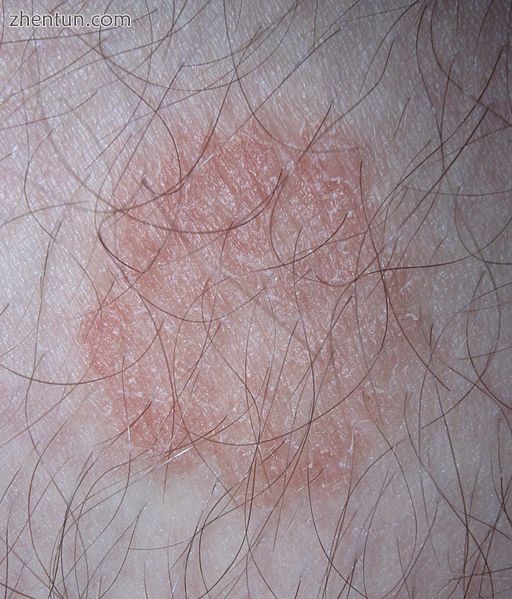 Ringworm on a human leg.jpg