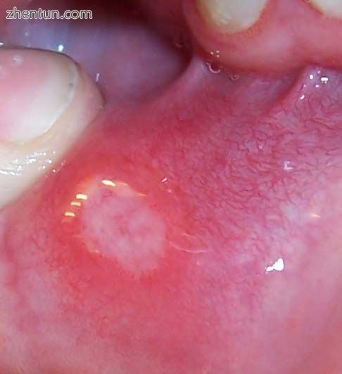 Canker sore on the lower lip.jpg