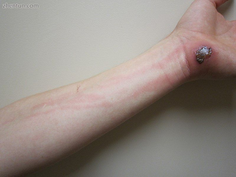 Cellulitis following an abrasion.jpg