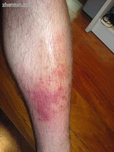 Skin cellulitis.jpg