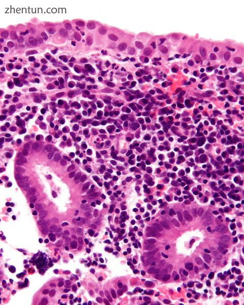Micrograph showing a chronic endometritis with the characteristic plasma cells. .jpg