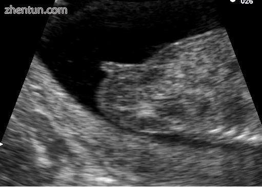 Genital tubercle of female at fourteen weeks.jpg