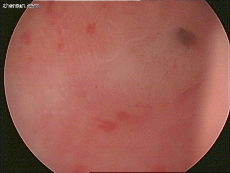 A falloposcope would enter the proximal tubal ostium identified here via hysteroscopy.jpg