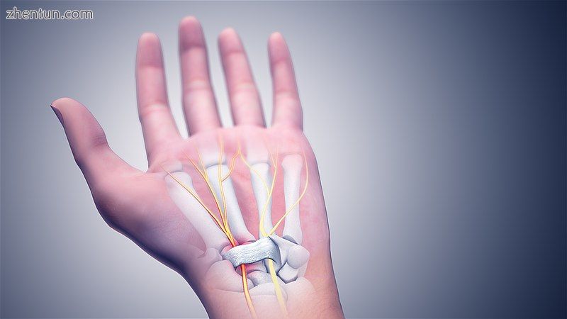 3D medical animation still of Carpal Tunnel Syndrome.jpg