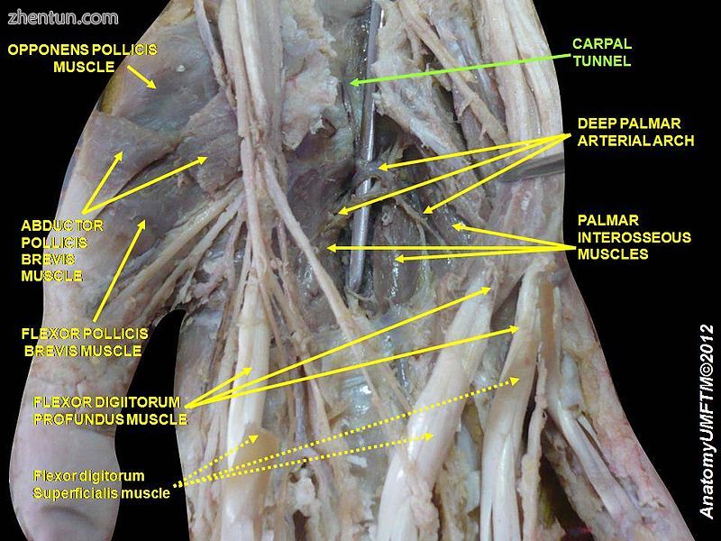 Carpal tunnel2.jpg