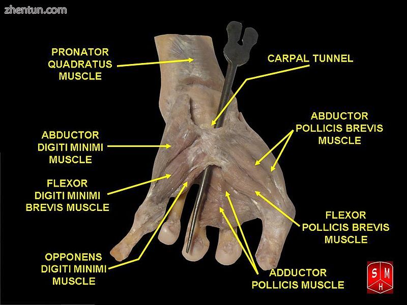 Carpal tunnel3.jpg