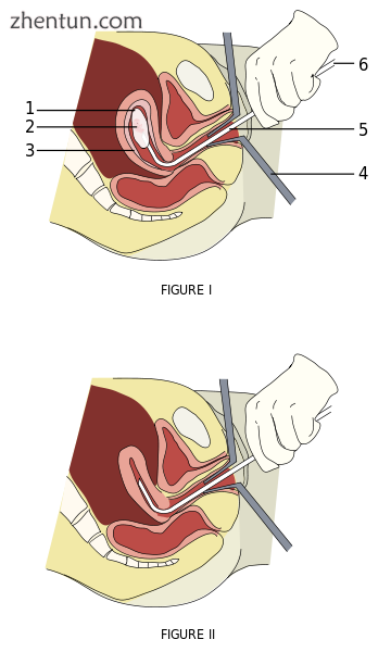 A diagram of a vacuum aspiration abortion procedure at 8 weeks gestation..png