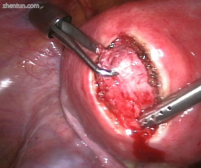 A laparoscopic myomectomy.jpg