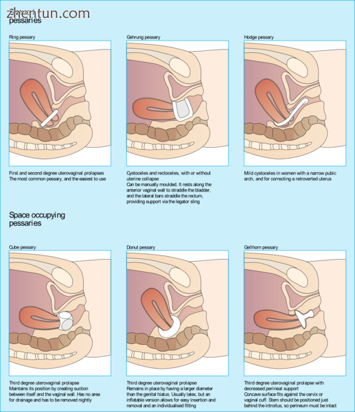 Different types of pessaries.png