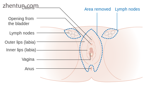 A 3 in 1 incision vulvectomy.png