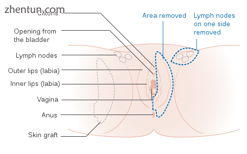 A partial vulvectomy of one side of the vulva.png