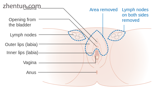 A partial vulvectomy of the top area of the vulva.png