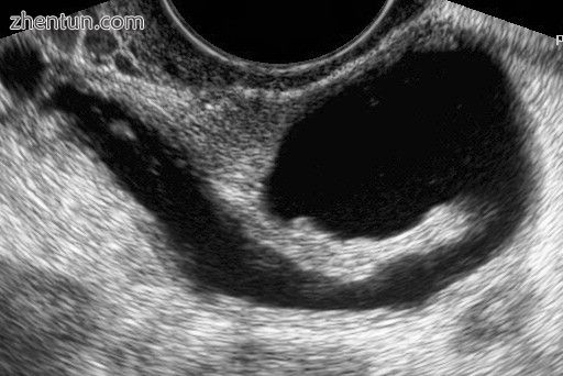 Left hydrosalpinx on gyn. ultrasonography.jpg