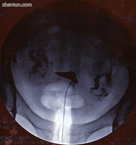 A normal hysterosalpingogram. Note the catheter entering at the bottom of the sc.jpg