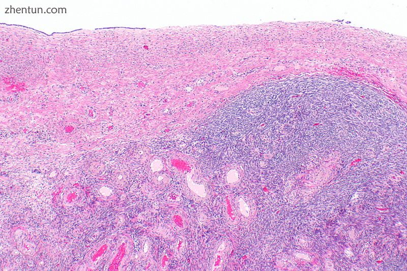 Ovarian serous cystadenoma. The cystic space is at the top of the image. Ovarian.jpg