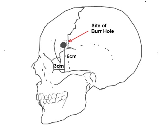 Site of borehole for the standard pre-frontal lobotomy.jpg