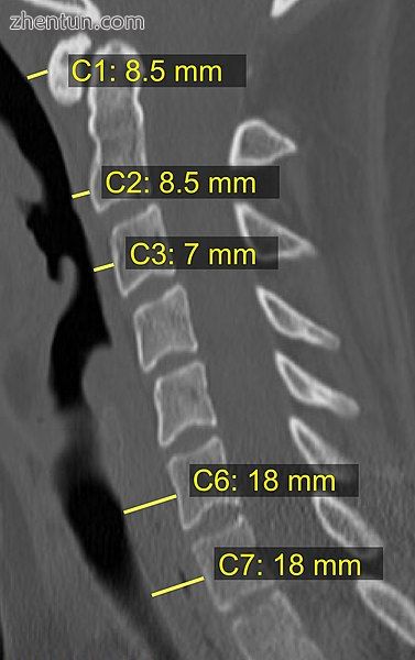 CT scan with upper limits of the thickness of the 椎前间隙 at differen.jpg