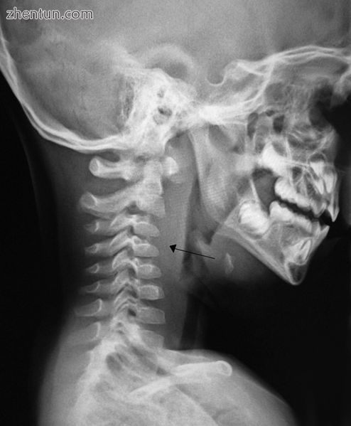 Retropharyngeal 脓肿.jpg