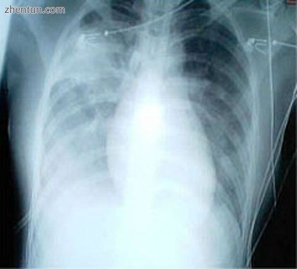 A chest X-ray showing increased opacity in both lungs, indicative of pneumonia, .jpg