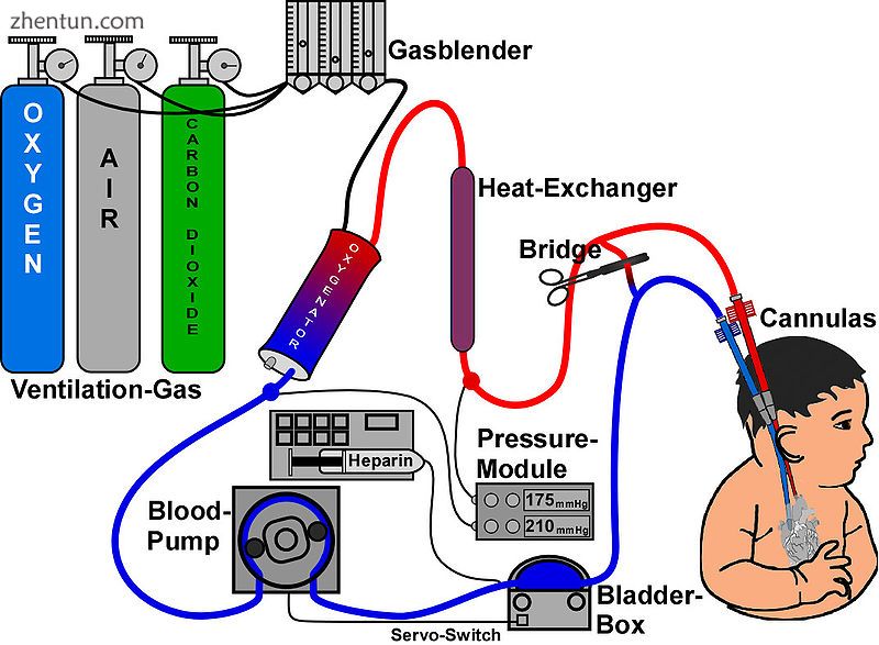 ECMO sketch.jpg