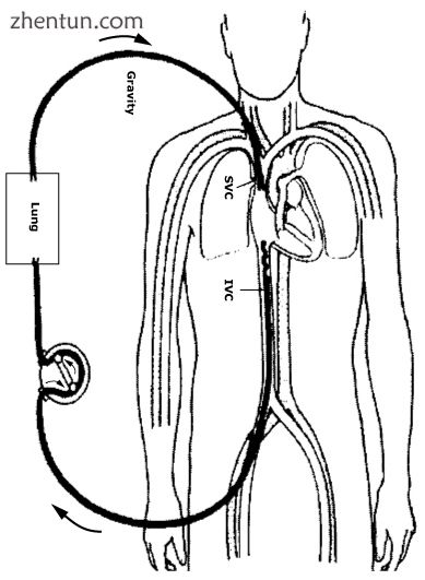 Veno-venous (VV) ECMO for respiratory failure.[17].jpg