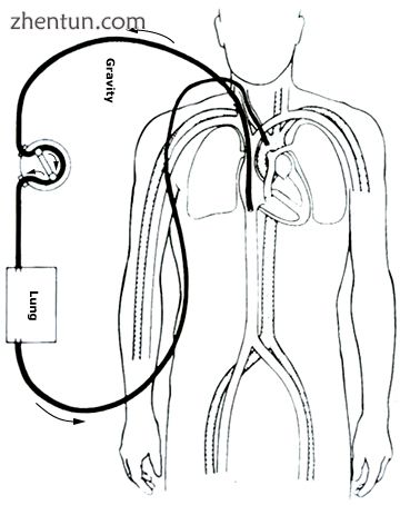 Veno-arterial (VA) ECMO for cardiac or respiratory failure.[17].jpg