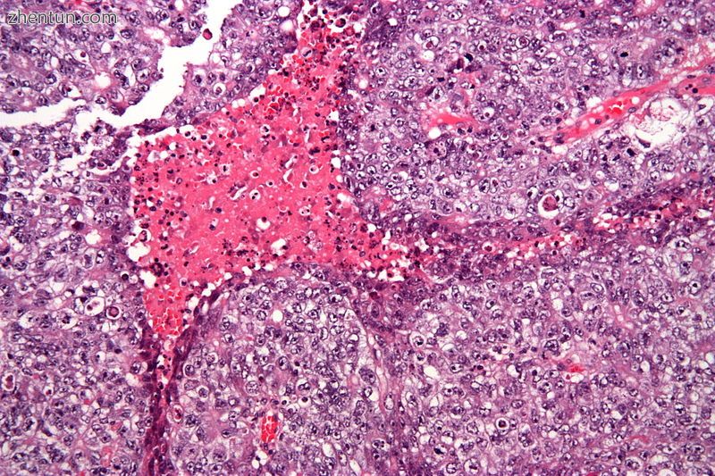 Embryonal carcinoma. H&amp;E stain..jpg