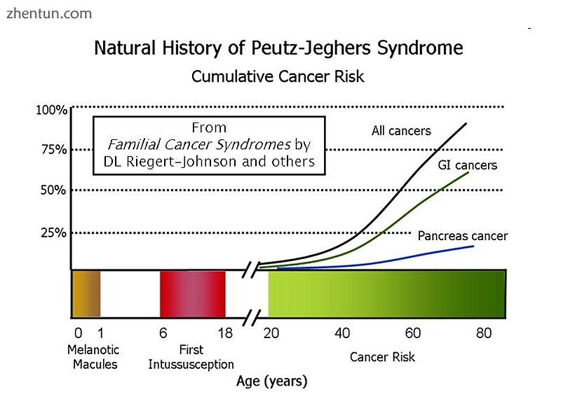Most people with Peutz-Jeghers syndrome will have developed some form of neoplas.jpg