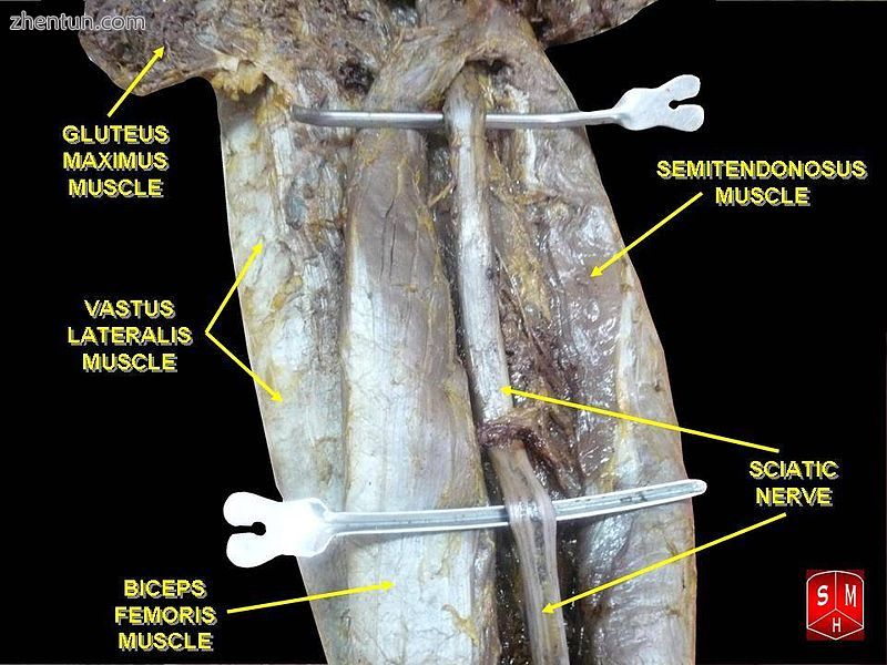 Sciatic nerve..jpg