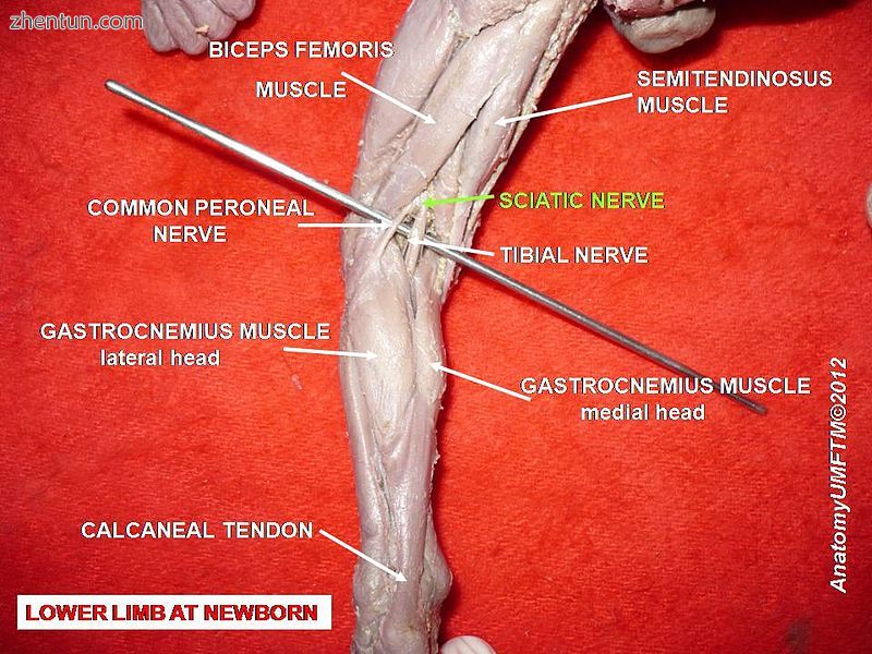 Sciatic nerve.2.jpg