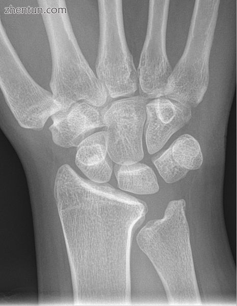 Negative ulnar variance..jpg