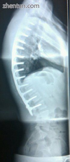 A post-operative X-ray of a 22-year-old male with Scheuermann&#039;s disease. Af.jpg