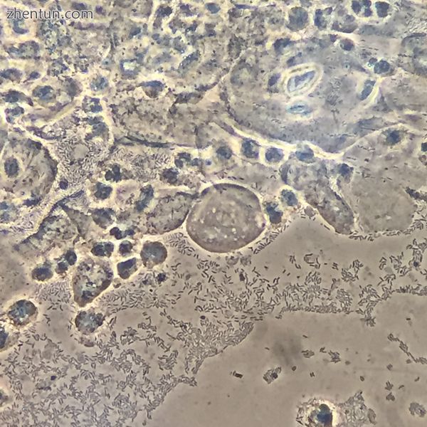 Aerobic vaginitis (in a 14-week pregnant woman) parabasal cells, absent lactobac.jpg