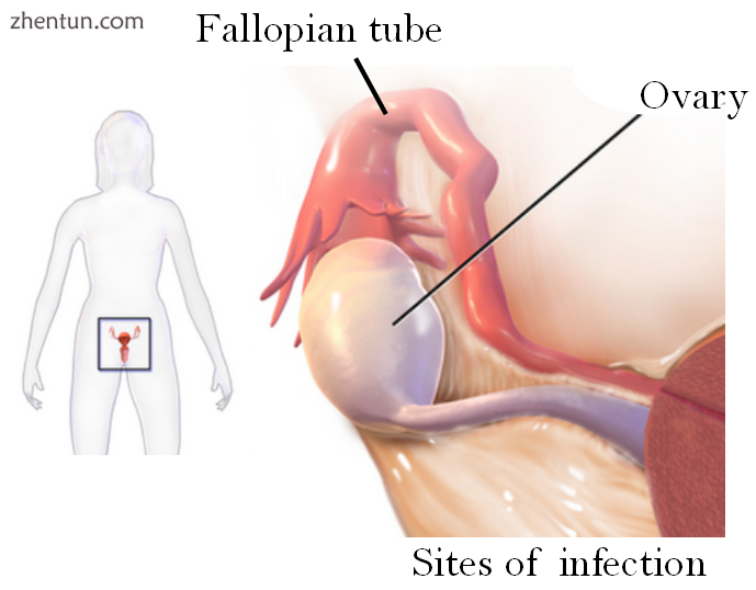 Drawing showing the sites of Tubo-ovarian 脓肿.png