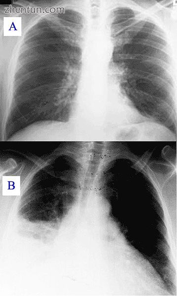 Pneumonia as seen on chest x-ray..jpg