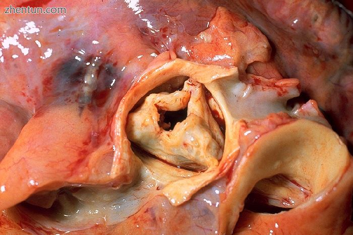 A stenotic aortic valve.jpg