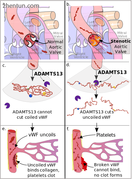 Pathophysiology of Heyde&#039;s Syndrome.png