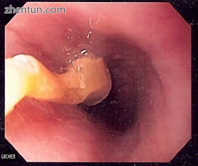 Image of a piece of food obstructing the esophagus, a complication in lymphocyti.jpg
