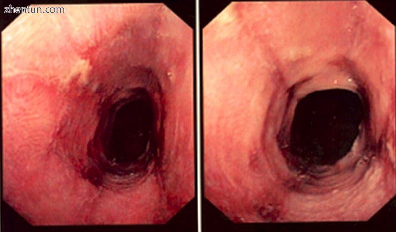 Endoscopic image of lymphocytic esophagitis, demonstrating narrow 内腔 esophagu.jpg