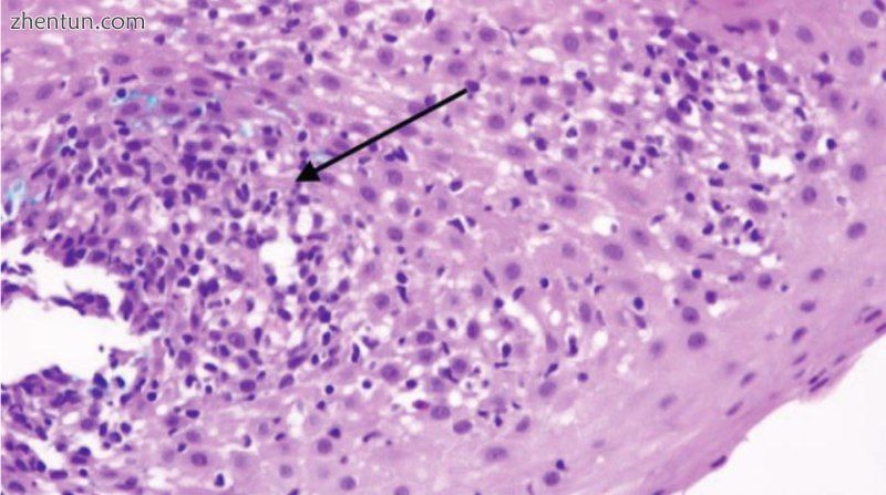 Pathology image of lymphocytic esophagitis.jpg