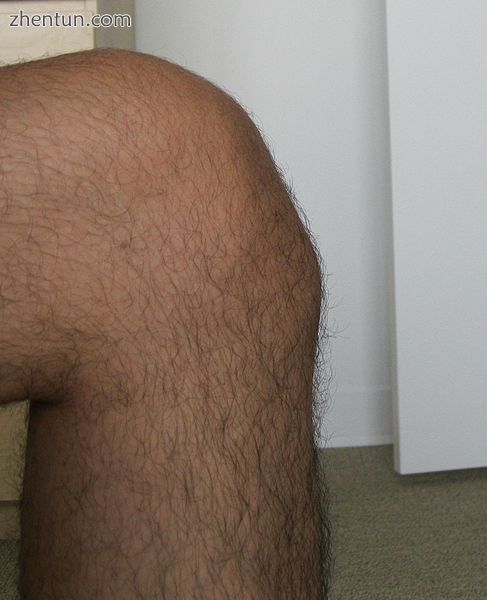Knee of a male with Osgood–Schlatter disease.jpg