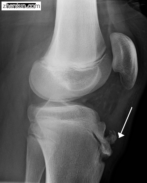 Lateral view X-ray of the knee demonstrating fragmentation of the tibial tubercl.png