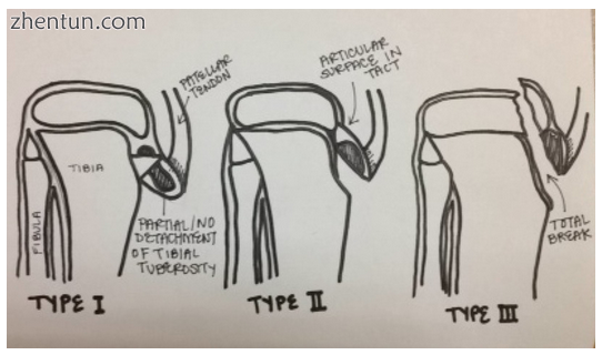 Three 类型 of avulsion fractures..png