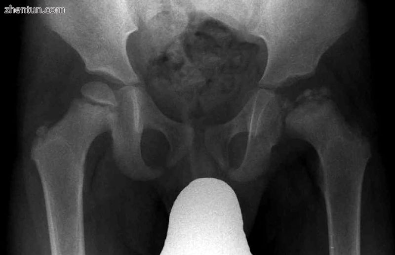 Radiograph of a person with Legg–Calvé–Perthes disease.jpg
