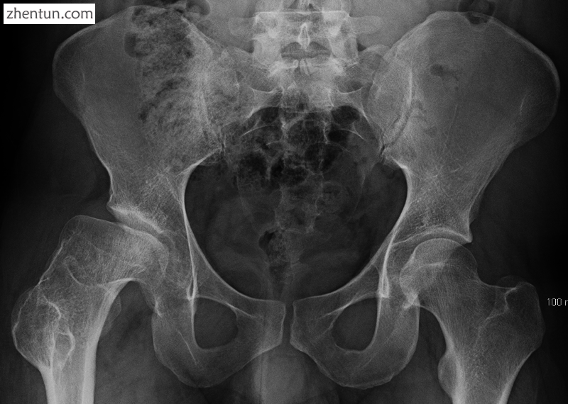 X ray of deformity by Legg–Calvé–Perthes disease of the right hip (left side .png