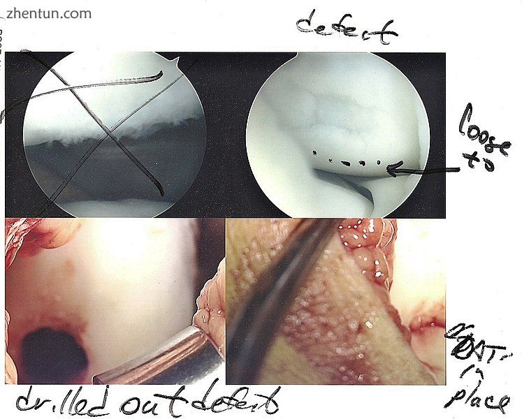 Arthroscopic image of OATS surgery on the medial femoral 骨节 of the knee.jpg
