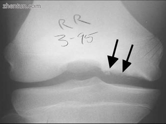 Tunnel or notch view X-ray of the right knee from a patient with osteochondritis.jpg