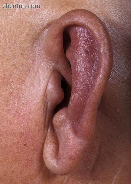 Ear inflammation with sparing of ear lobe in a person with relapsing polychondritis[2].jpg