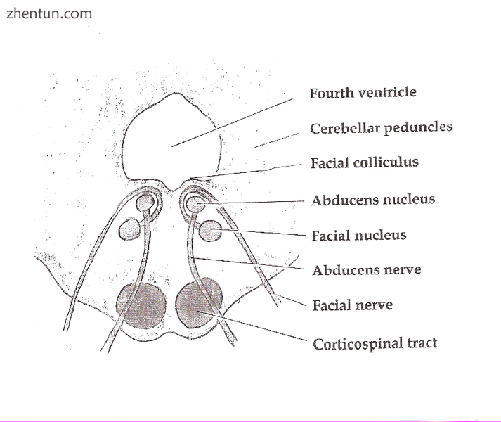 Axial section of the Brainstem (Pons) at the level of the Facial Colliculus.png